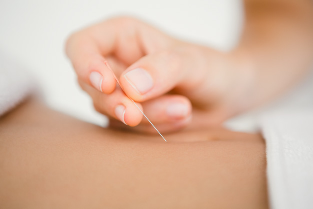Lower abdominal application of acupuncture needle.