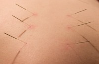 Wound handle filiform needles are used on the back.