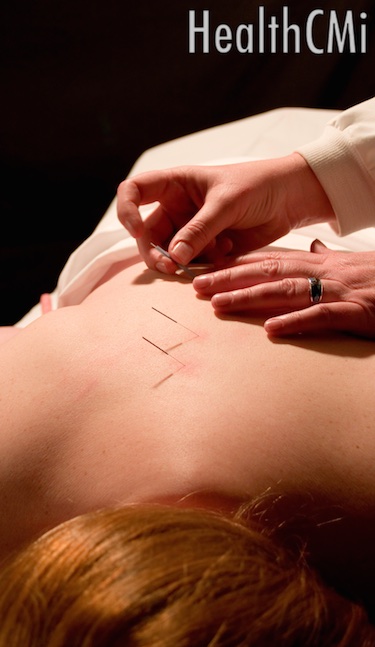 Back shu points with copper handle needles.