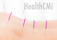 UB Shu points with Japanese thin needles are shown in this image.