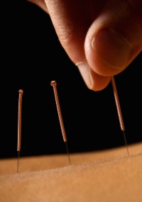 Copper spring handle filiform needles.