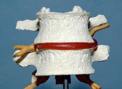Spinal disc disorder